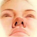 Синдром пустого носа