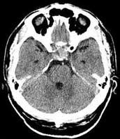 Pituitary CT