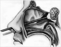 Pituitary surgery2