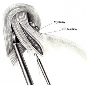 Laparoscopy achalasia