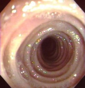 esophageal ring