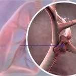 lung tumor