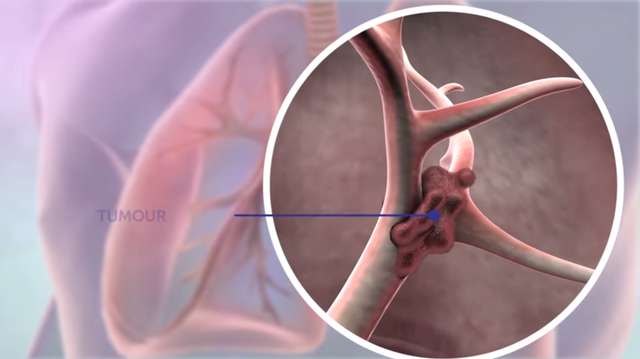 lung tumor