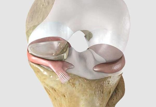 Knee treatment with Implant NUsurface in Israel