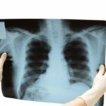 Chest wall reconstrustion at leading Israeli cardiosurgeons