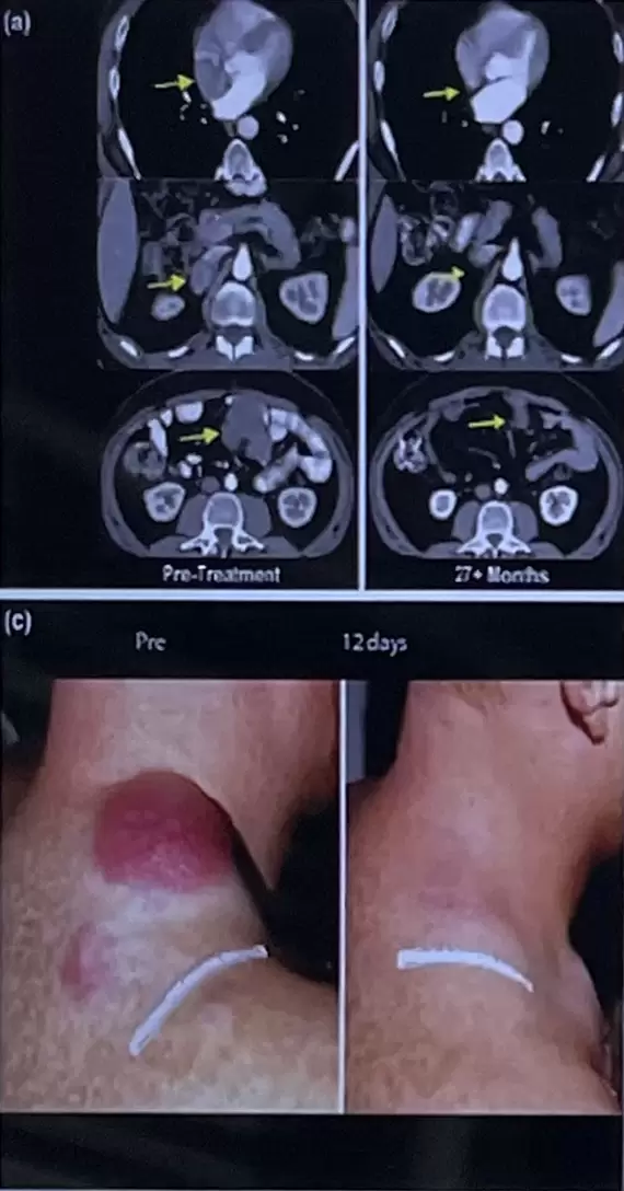 TIL therapy for melanoma