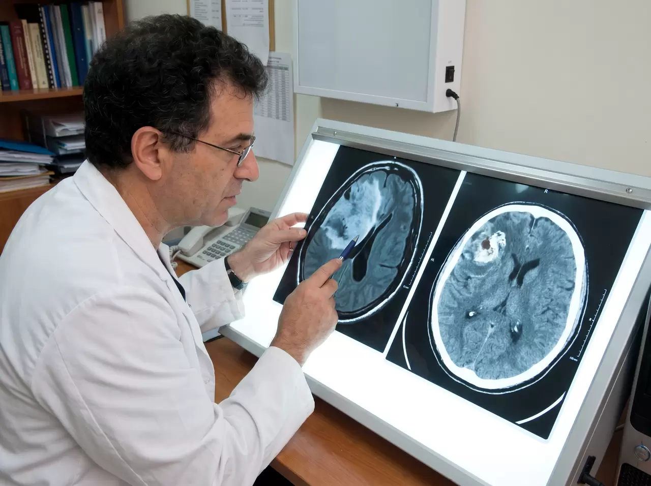 Israeli radiologist evaluates an astrocytoma in the brain